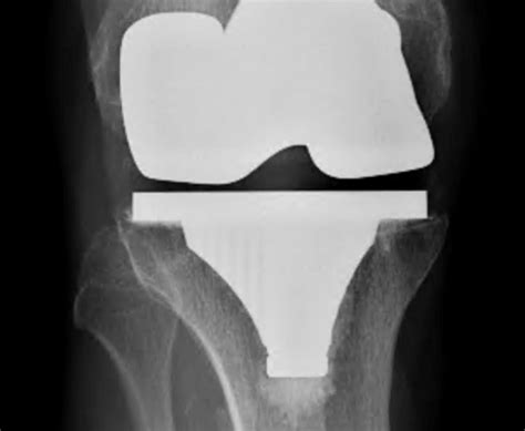 Secondary Patellar Resurfacing as a Rescue Procedure for 